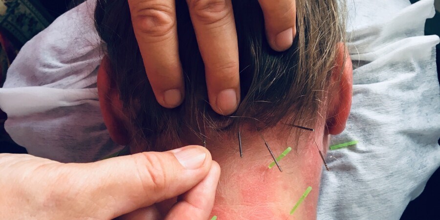 2 dages kursus: WHO Standard Skalp Akupunktur