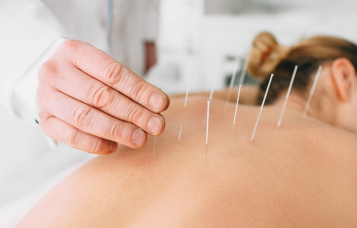 Akupunktur: En effektiv løsning på overgangsalderens udfordringer