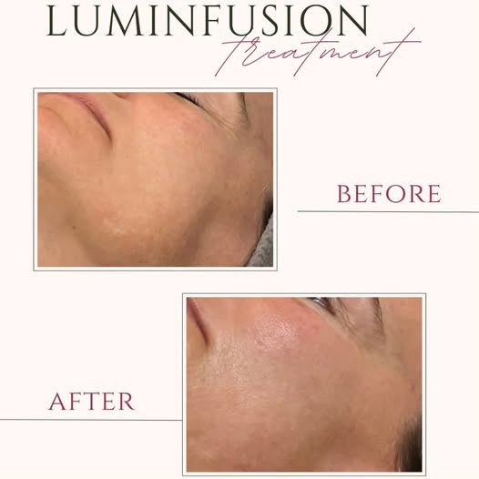 Skin By Vitting glæder sig til at tilbyde Dermalogica LuminFusion som glow-behandling