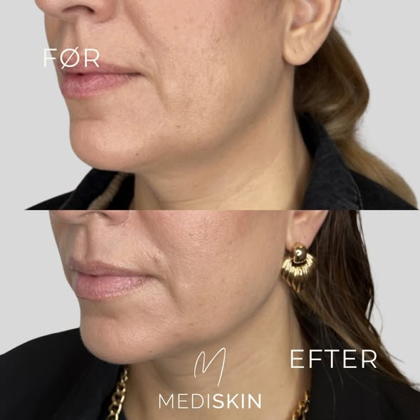 MediSkin fremhæver kundens kæbelinje med målrettet fillerbehandling