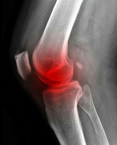 Fokus på artrose: En aften om hofte- og knæproblematikker i Kolding