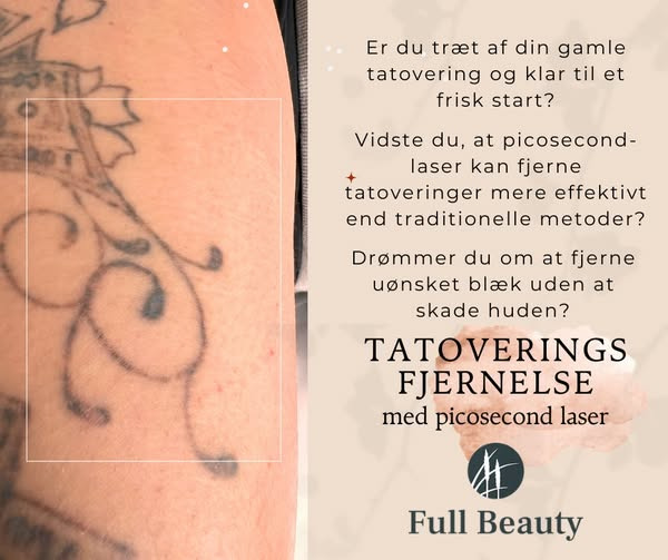 Full Beauty Aalborg tilbyder skånsom og effektiv tatoveringsfjernelse