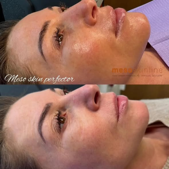 Hair & Skin Zone lancerer forbedret BB Glow behandling med langvarige resultater