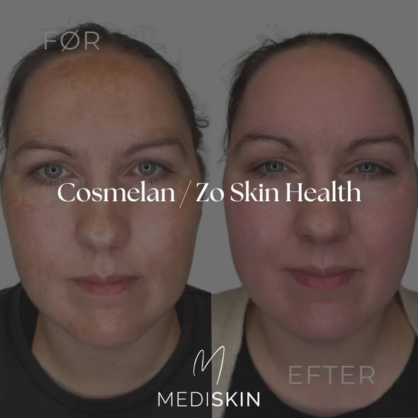 Mediskin introducerer signaturforløb med Cosmelan og ZO til hudforbedring