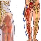 Brandsborgs Kropsterapi tilbyder lindring mod piriformis syndrom smerter