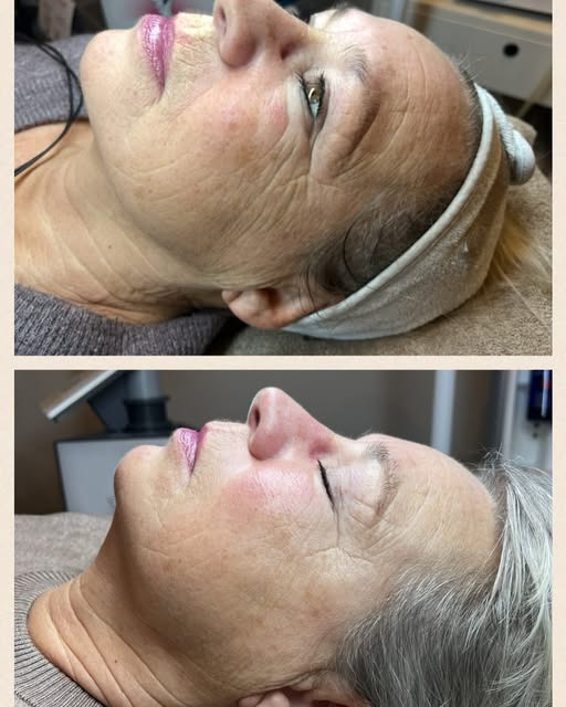 Kunde oplever 10 år yngre udseende med behandlinger fra Hair & Skin Zone