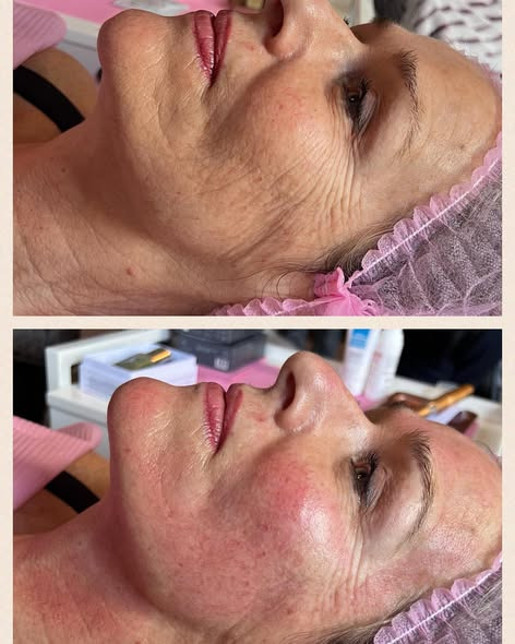 Effektiv forvandling med Hair & Skin Zones innovative microneedling-behandling