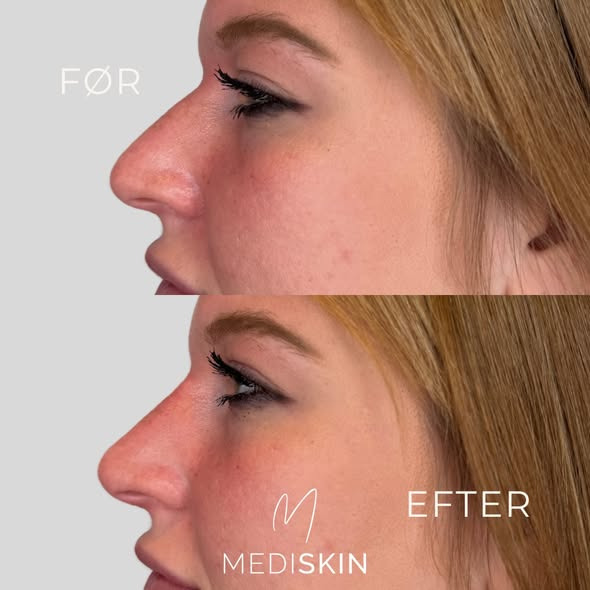 MediSkin understreger vigtigheden af sikkerhed ved fillerbehandlinger af næsen