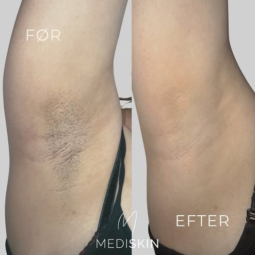 MediSkin deler kundens rejse mod glattere hud gennem hårfjerning med laser