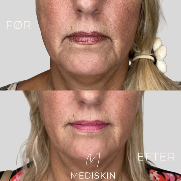 MediSkin kombinerer botox og filler for at løfte området omkring mundvigene