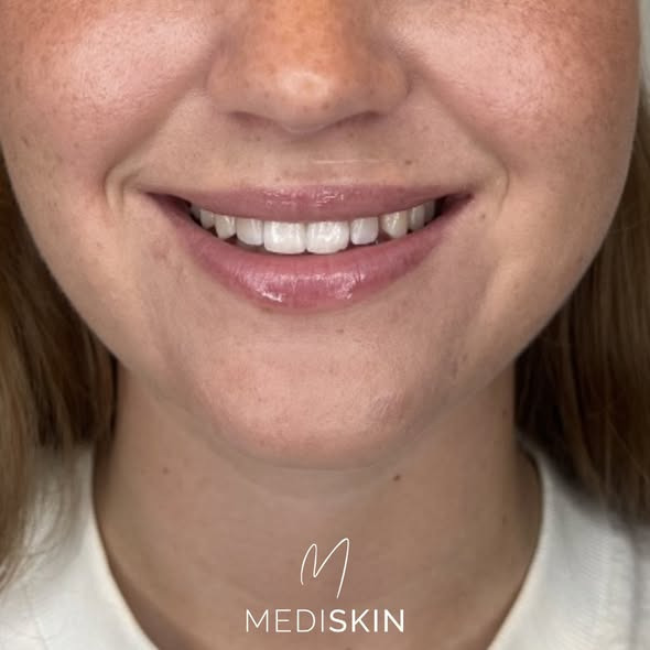 Mediskin fremhæver fordelene ved et lipflip