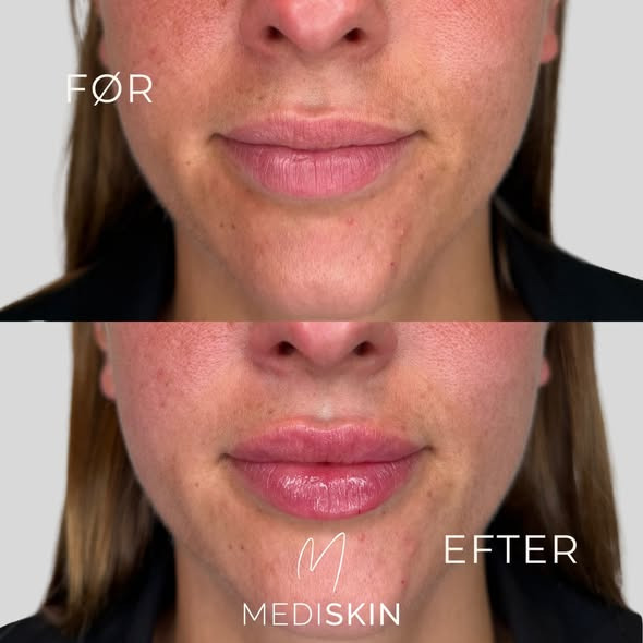 Få naturligt symmetriske læber med MediSkin