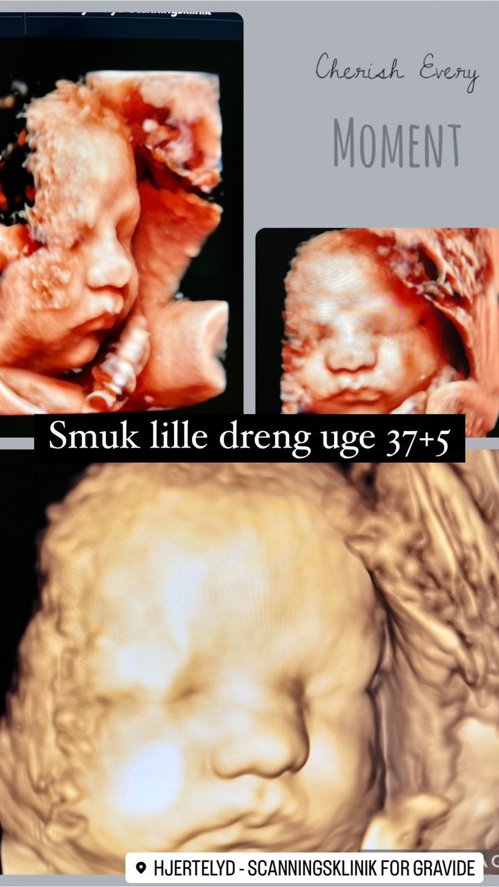 Hjertelyd - scanningsklinik for gravide: Babys position er perfekt for fødsel