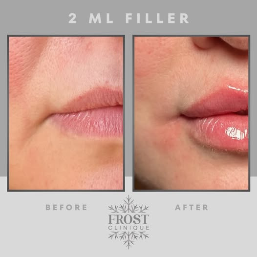 Frost Clinique deler tips til at forbedre mundvigenes udtryk med filler og Botox