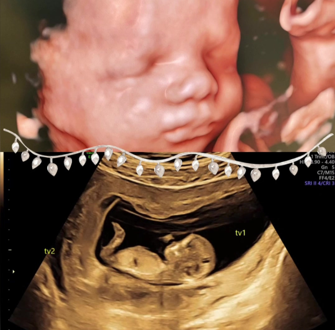 Hjertelyd Scanningsklinik Tilbyder juleoverraskelser for kommende forældre