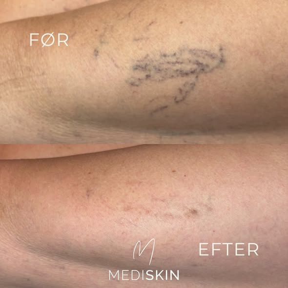 MediSkin tilbyder behandling af karsprængninger på benene