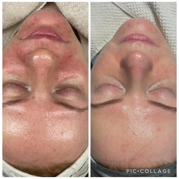 Viborg Hudpleje fremhæver imponerende resultater med skræddersyet hudpleje og lysbehandling