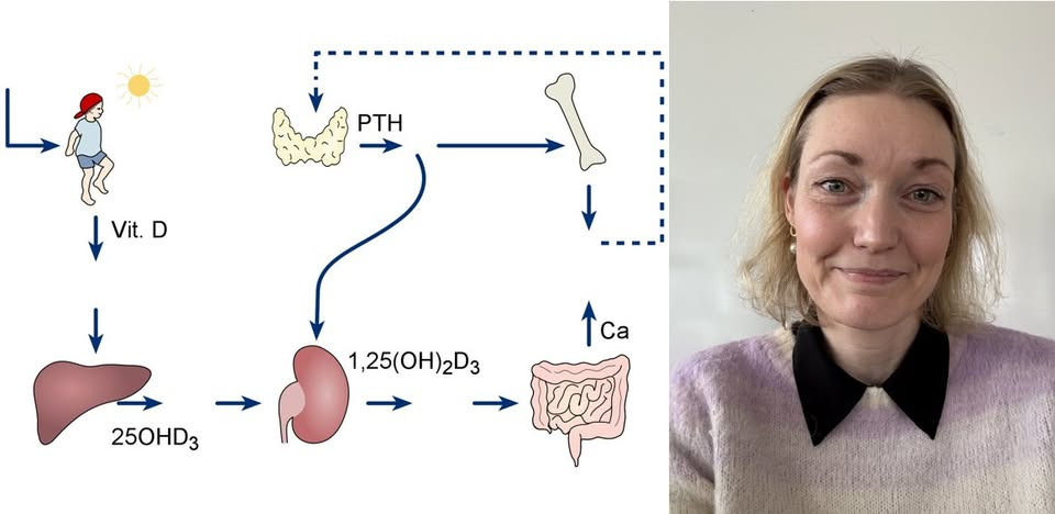 Osteoporoseforedrag i Kolding udforsker kalkstofskiftets betydning