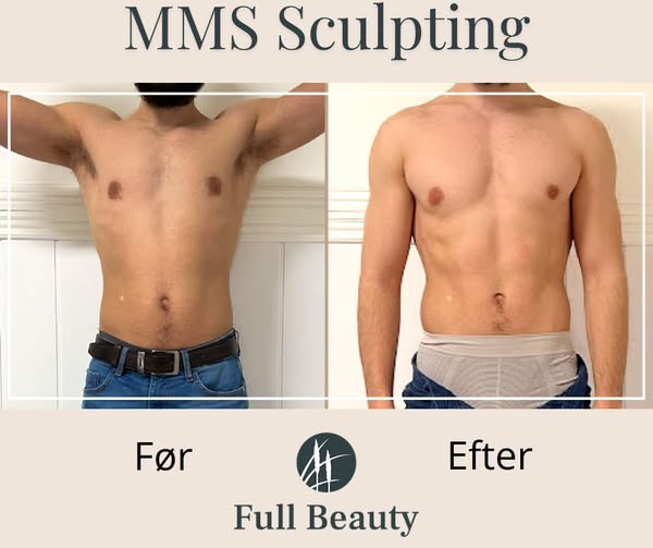 Full Beauty Aalborg viser resultater med MMS Sculpting efter 10 behandlinger