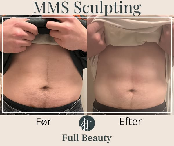 Full Beauty Aalborg tilbyder gratis konsultation om MMS Sculpting