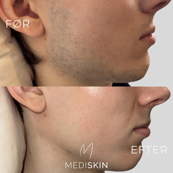 MediSkin tilpasser laserhårfjerning af skægvækst til dine ønsker