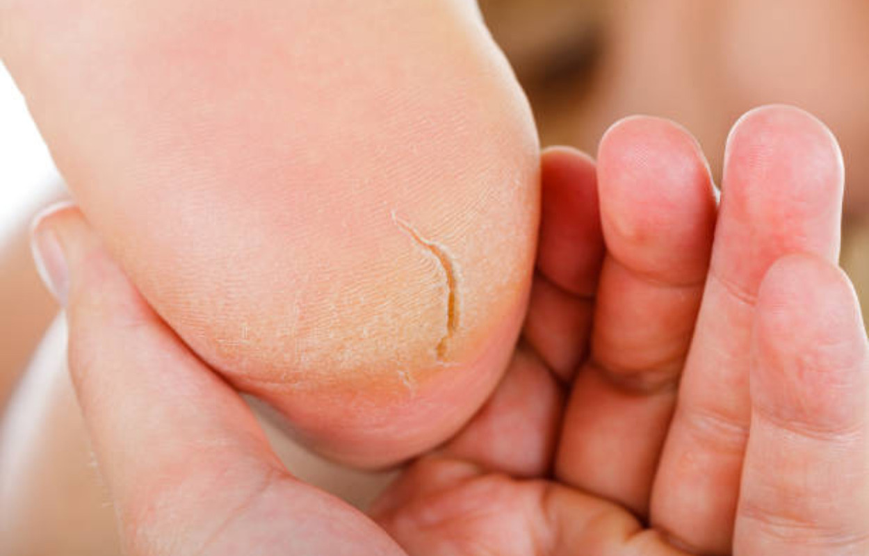 Løsningen på hælrevner: Dommerby Fodklinik tilbyder den rette pleje