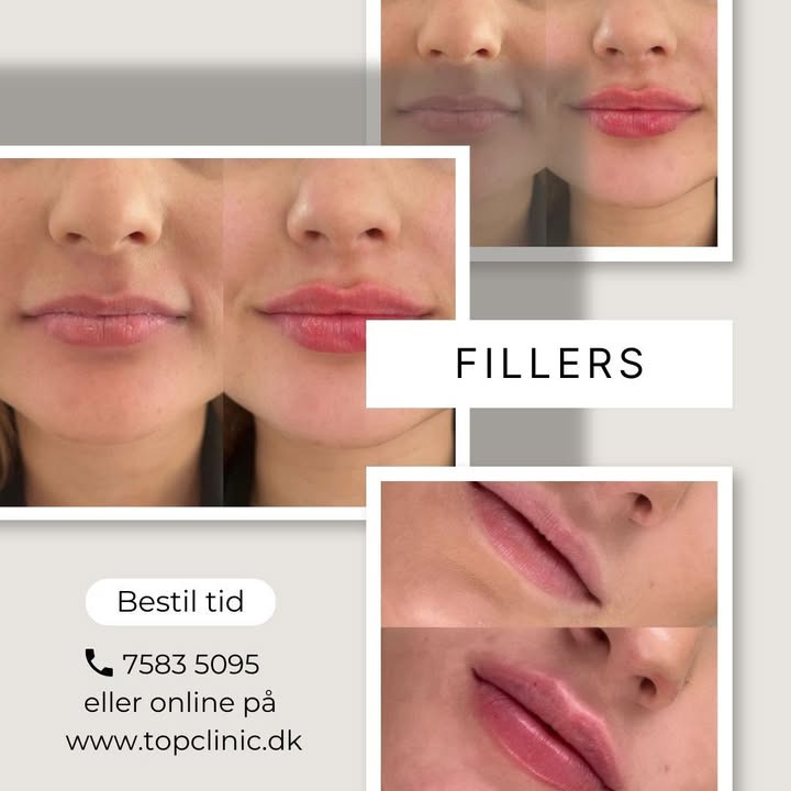 Opnå fylde og korrigér ansigtslinjer hos Top Clinic v/Else Møller Larsen med fillers og Sunekos behandlinger