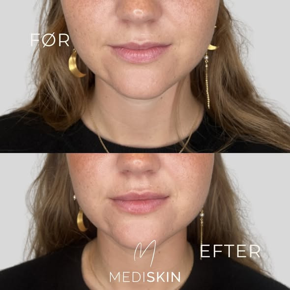 MediSkin tilbyder skræddersyede behandlinger til dine unikke læber