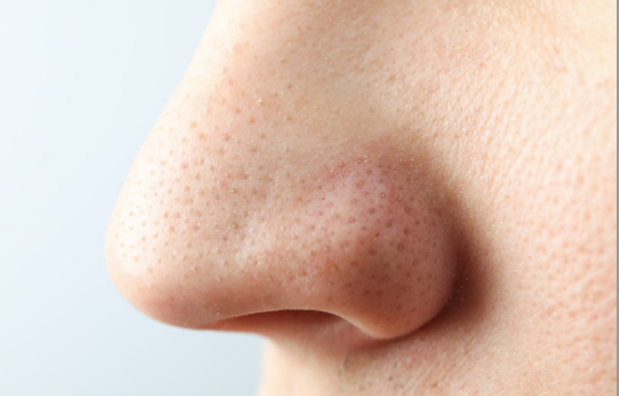 Plaget af sorte prikker på næsen?