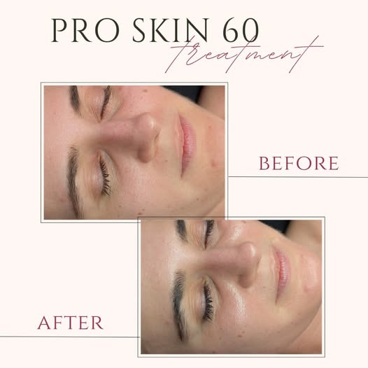 Opnå wow-glød med ProSkin 60 ansigtsbehandling hos Skin By Vitting