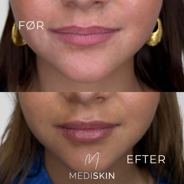 MediSkin fremhæver naturlig læbeforfinelse frem for forandring