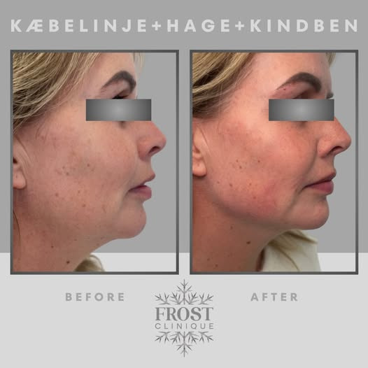 Frost Clinique fordeler 4 ML i ansigtet for mere markering, symmetri og balance
