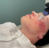 Effektiv hudbehandling med SkinPen hos Cosmo Laser i Vejle