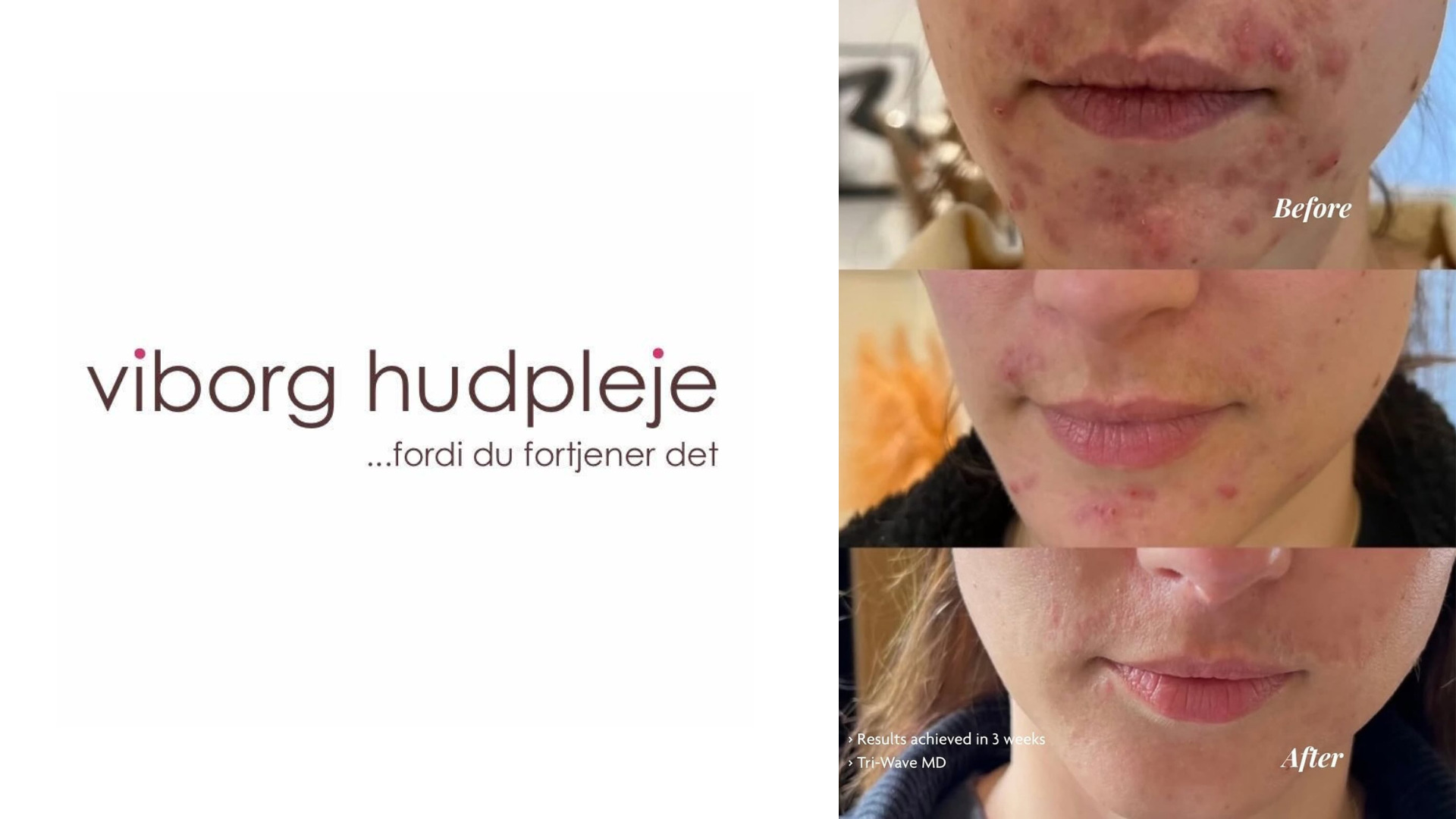 En banebrydende lysbehandling, hvor avanceret teknologi løfter hudpleje til et nyt niveau