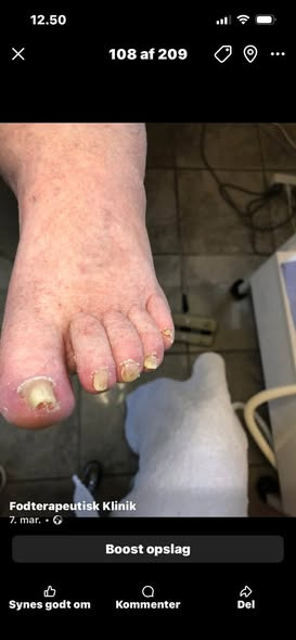 Fodterapeutisk Klinik v/Lajla Andersen viser imponerende forskel efter behandling mod neglesvamp