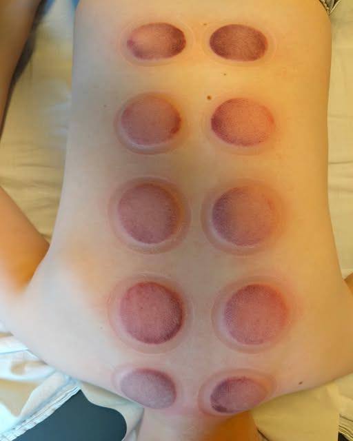 Klinikken på Nørregade tilbyder cupping ved ryg- og nakkesmerter efter hurtig vækst