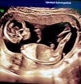 Populær tidlig kønsscanning tilbyder forældre valgmulighed om at kende barnets køn fra 14. uge af graviditeten