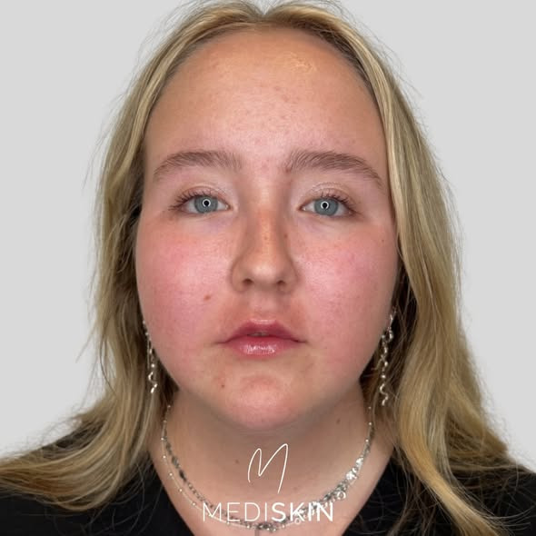 MediSkin viser et naturligt læberesultat skabt over 2 behandlinger