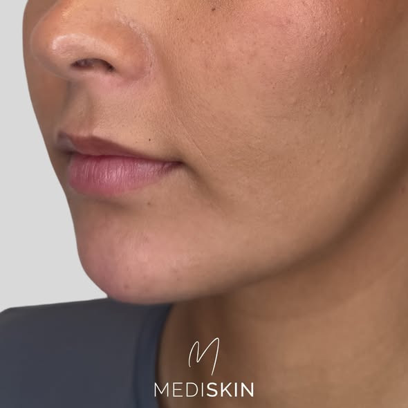 Mediskin fremhæver naturlige resultater med hagefiller