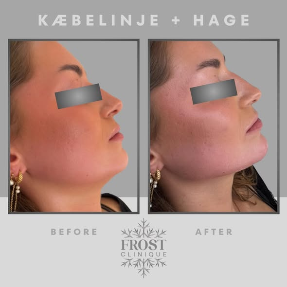 Frost Clinique skaber et mere skarpt, harmonisk og symmetrisk udtryk med 3 ML