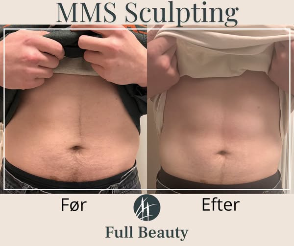 Full Beauty Aalborg tilbyder MMS Sculpting til mere tonede muskler