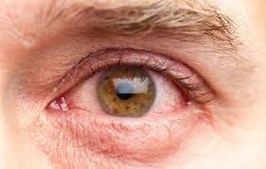 Nyt Syn Støvring ApS advarer: Vælg øjendråber uden konserveringsmidler i allergisæsonen