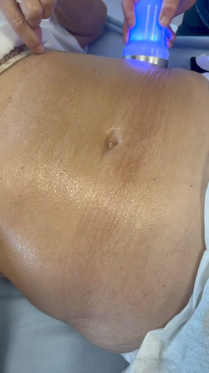 Actera Klinik Aarhus v/ Helle Hansen tilbyder fedtfrysning og hudopstramning til reducerede priser