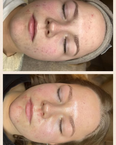 Hair & Skin Zone introducerer Meso AcnePeel til behandling af uren hud og acne-ar