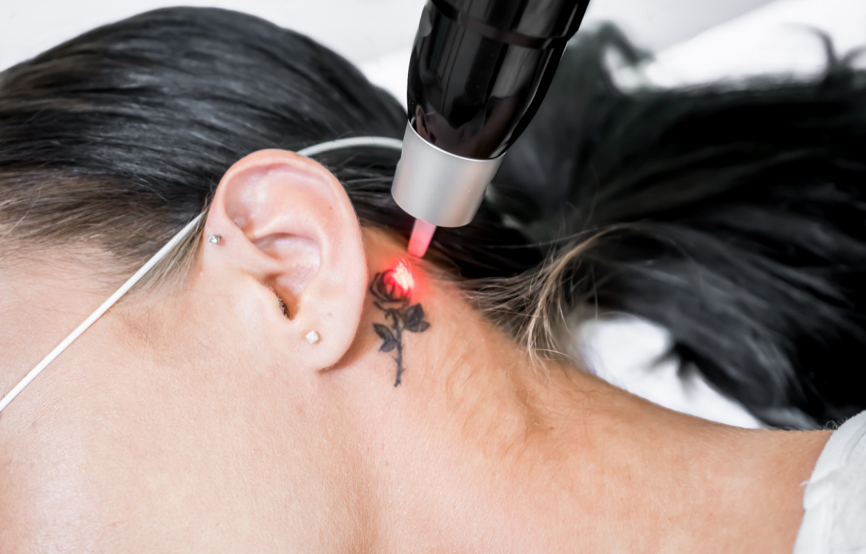 Få fjernet fedt og tatoveringer i Køge