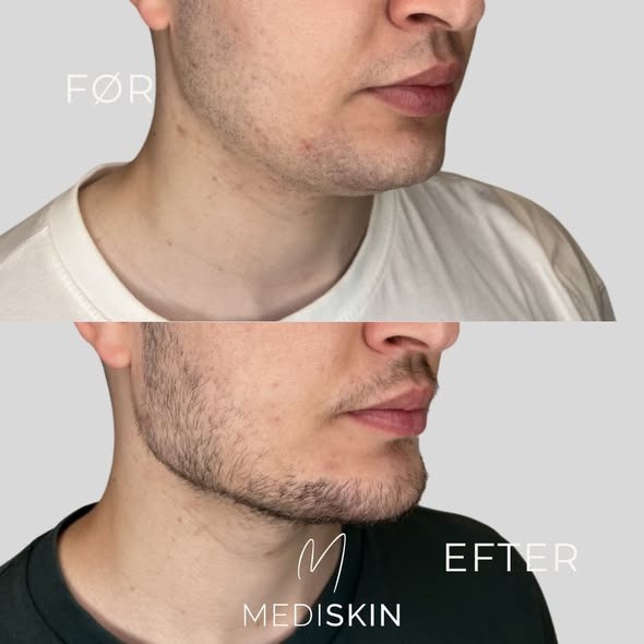 Flere mænd vælger kosmetiske behandlinger hos MediSkin
