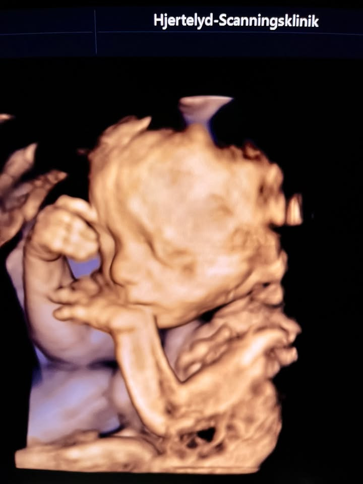 Hjertelyd - scanningsklinik for gravide: 91-årig oplever ultralyd for første gang under besøg fra Dragør