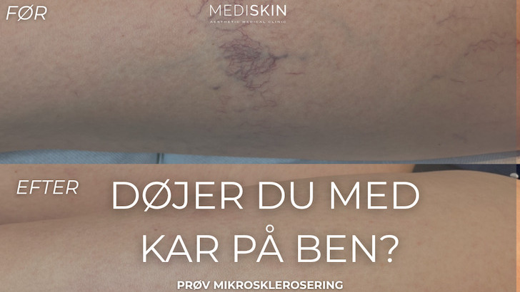 MediSkin: Effektiv behandling af synlige kar