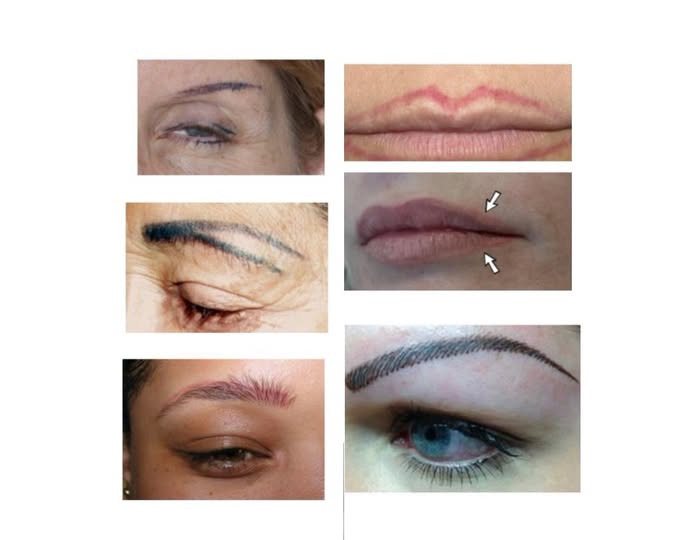 Hair & Skin Zone tilbyder skånsom laserfjernelse af permanent makeup