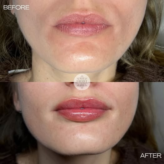 Frost Clinique fordeler 0,5 ml filler på over- og underlæbe